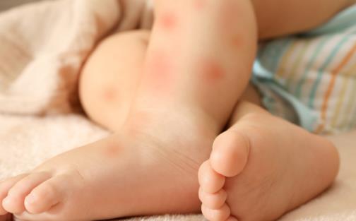 皮膚高度過敏怎么保濕 方法在這里